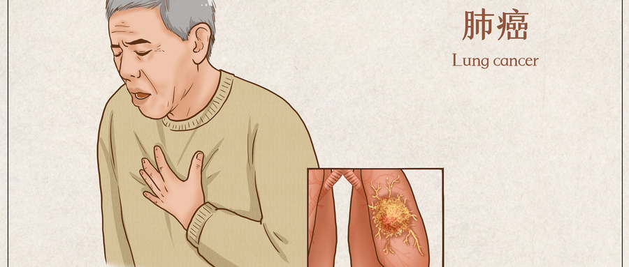 四川治肺癌医院哪家好？ 3 大晚期明显症状，中医调理有方向